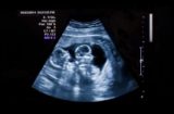 Ultrasound showing mother is Pregnant with twins!